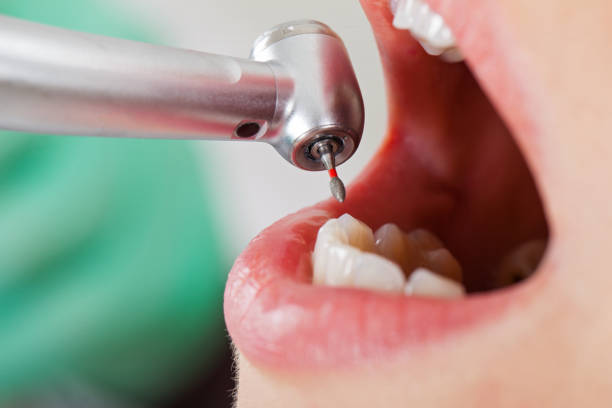 Best Emergency Tooth Extraction in Spencer, IN
